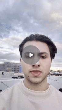 Michael — Men’s Hair Loss